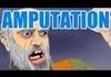 amputation